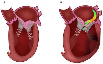 Trends in Ischemic Mitral Regurgitation Following ST-Elevation Myocardial Infarction Over a 20-Year Period